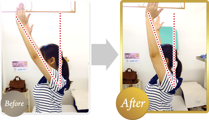 慢性的な肩こりの改善例